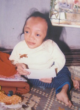 Agent-Orange-Opfer
                              Dao Thi Hoan: Dao Thi Hoan, geboren 1977,
                              aus der Provinz Vinh Phuc