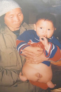 Agent-Orange-Opfer To Hoai
                              Nam: To Hoai Nam, geboren 1997, aus dem
                              Dorf Nguyen Khe, Distrikt Dong Anh, Stadt
                              Hanoi