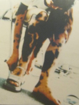 Agent-Orange-Opfer Nguyen Thi
                              Kim Thoa: Nguyen Thi Kim Thoa, geboren
                              1985, aus der Stadt Thai Binh, Provinz
                              Thai Binh