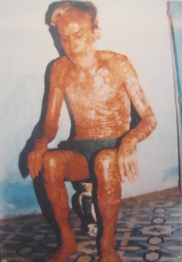 Agent-Orange-Opfer Tran
                              Van Suu: Tran Van Suu, geboren 1937, aus
                              der Gemeinde Phu Thuong, Distrikt Tay Ho,
                              Stadt Hanoi