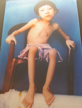 Agent-Orange-Opfer Doan Thi My Dung:
                              Doan Thi My Dung, geboren 1991, aus der
                              Gemeinde Thach Trung, Stadt Ha Tinh