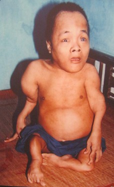 Agent-Orange-Opfer Dang Xam: Dang
                              Xam, aus der Gemeinde Vinh Ha, Distrikt
                              Phu Vang, Provinz Thua Thien Hue