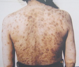 Agent-Orange-Opfer Hoang Thi Ngoc
                              Van: Hoang Thi Ngoc Van, geboren 1945 aus
                              der Provinz Quang Binh.