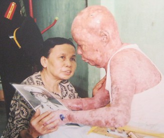 Agent-Orange-Opfer
                              Tu Duc Phang: Tu Duc Phang, 63 Jahre alt,
                              aus dem Stadtbezirk Puhuoc Long, Stadt Nha
                              Trang, Provinz Khanh Hoa
