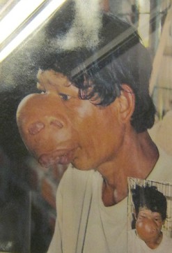 Agent-Orange-Opfer Vo Van Khiem: Vo
                              Van Khiem - geboren 1965, aus dem Distrikt
                              Phu Cat, Provinz Binh Dinh. Seine
                              Krankheit war ein Weichgewebe-Tumor im
                              Gesicht. Foto: Nishimura Yaichi