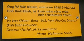 Agent-Orange-Opfer Vo Van Khiem,
                              Text: Vo Van Khiem - geboren 1965, aus dem
                              Distrikt Phu Cat, Provinz Binh Dinh. Seine
                              Krankheit war ein Weichgewebe-Tumor im
                              Gesicht. Foto: Nishimura Yaichi
