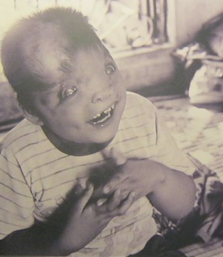 Agent-Orange-Opfer Do Duc Duyen: Der
                              8 Jahre alte Do Duc Duyen nach dem
                              Fr�hst�ck, er macht Witze mit seiner
                              Mutter Huong. Duyens Lebensmut hat es
                              seinen Eltern erm�glicht, ihre
                              Schwierigkeiten zu �berwinden, und er er
                              gibt ihnen weiterhin St�rke durch seine
                              Lebenslust. Foto: Doan Duc Minh