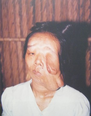 Agent-Orange-Opfer
                              Tran Thi Huong: Tran Thi Huong aus dem
                              Dorf 3, Stadtteil Van Hai, Distrikt Binh
                              Chanh, Saigon (Ho Chi Minh-Stadt)