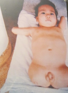 Agent-Orange-Opfer
                              Huynh Huong Hoai: Huynh Huong Hoai,
                              geboren 1996, vom Distrikt Cu Chi in
                              Saigon (Ho Chi Minh-Stadt) [ohne Beine und
                              mit Stummelarmen]