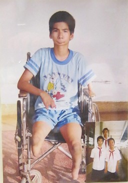 Agent-Orange-Opfer Nguyen Minh Phuc:
                              Nguyen Minh Phuc - geboren 1990 - Provinz
                              Tay Ninh. Krankheit: Angeborenes Syndrom
                              mit zusammengezogenen B�ndern [die
                              Unterschenkel sind Stummel, der linke Arm
                              ist ein Stummel, und die rechte Hand hat
                              nur Stummelfinger] Foto: Nishimura Yoichi