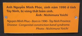 Agent-Orange-Opfer Nguyen Minh Phuc,
                              Text: Nguyen Minh Phuc - geboren 1990 -
                              Provinz Tay Ninh. Krankheit: Angeborenes
                              Syndrom mit zusammengezogenen B�ndern
                              Foto: Nishimura Yoichi
