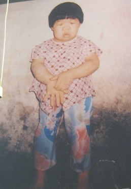 Agent-Orange-Opfer Pham Thi Thuong:
                              Pham Thi Thuong, geboren 1972, aus der
                              Gemeinde Binh Phu, Stadt Ben Tre, Provinz
                              Ben Tre [der Person fehlt der Hals, das
                              Gesicht ist mongoloid, die Person leidet
                              unter Hautkrankheiten]