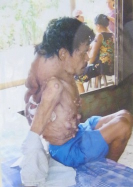 Agent-Orange-Opfer Nguyen
                                    Van Bin