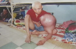 Agent-Orange-Opfer
                              Bui Nhat Quang: Bui Nhat Quang - geboren
                              1978 - Distrikt Ben Luc, Provinz Long An
                              Krankheit: Lymphangiom (Tumor der
                              Lymphgef�sse) [gigantischer Tumor am
                              linken Arm] Foto: Nishimura Yoichi