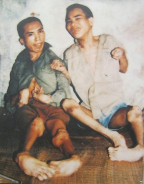 Zwei Agent-Orange-Opfer: Nguyen Van
                              Vuong und Nguyen Van Ba: Nguyen Van Vuong
                              und Nguyen Van Ba aus der Gemeinde Hong
                              Thai, Distrikt Kien Xuong, Provinz Thai
                              Binh [verformte H�nde, Beine und F�sse]