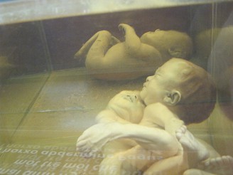 Agent-Orange-Opfer, deformierte
                              F�ten: Thorxo abdermine pagus