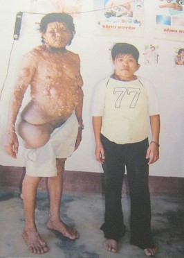 Zwei
                              Agent-Orange-Opfer mit
                              Recklinghausen-Krankheit: Luu Van Te und
                              Luu Thi Hoa: Agent-Orange-Opfer Luu Van Te
                              (geboren 1963) und Luu Thi Hoa (geboren
                              1986), Distrikt Lak, Provinz Lak.
                              Krankheit: Recklinghausen
                              [Von-Recklinghausen-Krankheit: ist eine
                              Neurofibromatose, eine
                              Multiorganerkrankung, betroffen sind vor
                              allem die Haut und das Nervensystem -
                              web01] Foto: Nishimura Yoichi