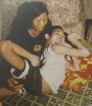 Agent-Orange-Opfer Ke Van Bac: Ke Van
                              Bac, geboren 1988, aus der Gemeinde A Ngo,
                              Distrikt A Luoi, Thua Thien Hue [v�llig
                              verformte Arme und Beine]