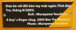 Agent-Orange-Opfer, Text:
                                          Die Hand dieses Jungen hat nur
                                          einen Finger (August 2005, Ben
                                          Tre Ministry) Foto: Murayama
                                          Yasufumi