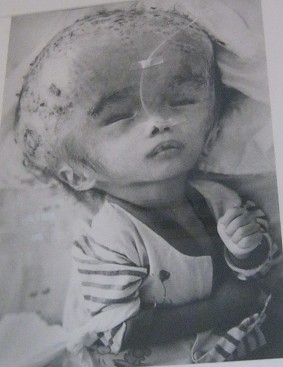 Agent-Orange-Opfer: Namenloses Baby,
                              es wurde aus der Provinz Vinh Long ins
                              Tu-Du-Spital [in Saigon / Ho Chi Minh
                              City] gebracht. Sie wurde im November 1998
                              mit Hydro-Enzephalitis geboren und starb
                              einen Monat nach diesem Foto.