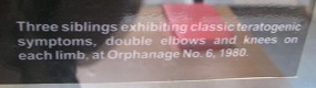 3
                                Agent-Orange-Opfer mit doppelten Armen
                                und Knien, Text: Drei Geschwister zeigen
                                teratogenische Symptome mit doppelten
                                Ellenbogen und doppelten Knien an allen
                                ihren Gliedern. Waisenhaus Nr. 6, 1980