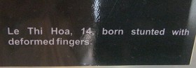 Agent-Orange-Opfer Le Thi Hoa,
                                  Text: Agent-Orange-Opfer Le Thi Hoa
                                  (14), wurde verk�mmert geboren und hat
                                  deformierte Finger