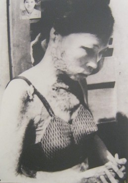 Napalmopfer Nguyen Thi Tu Oanh im
                              Januar 1970: Frau Nguyen Thi Tu Oanh wurde
                              im Januar 1970 durch eine Napalmbombe
                              verwundet - Provinz Quang Binh