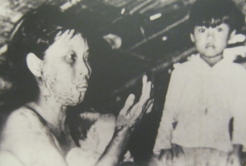 Phosphorbombenopfer Frau Nguyen Thi
                              Ut, neben ihr ihr Sohn: Beide, Frau Nguyen
                              Thi Ut und ihr Kind, wurden durch
                              Phosphorbomben verwundet.