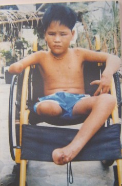 Minenopfer Ho Van Loi mit
                                          Stummelarm, das rechte Bein
                                          ist ganz weg und der linke
                                          Fuss ist weg