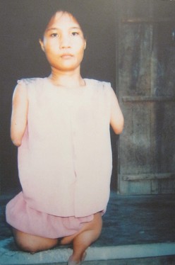 Agent-Orange-Opfer Huynh Thi Thuan