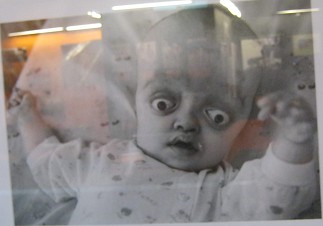 Agent-Orange-Opfer mit
                                kraniofazialer Dysostose